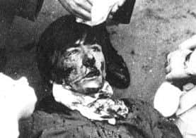 Michael Quinn after he was shot in the face on Bloody Sunday