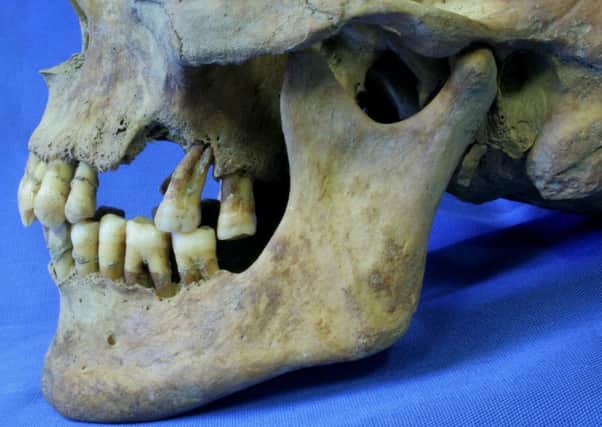 The studied focused on the teeth of 363 famine victims found in an unmarked grave in Kilkenny