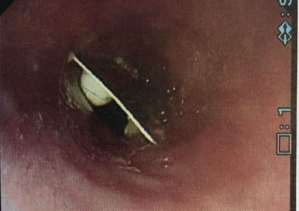 Photo of an examination taken of a packet of painkillers lodged in a woman's throat, which remained undetected by doctors for almost three weeks. Pic: BMJ Journals/PA Wire