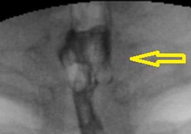 Photo of an X-ray taken of a packet of painkillers lodged in a woman's throat, which remained undetected by doctors for almost three weeks. Pic: BMJ Journals/PA Wire