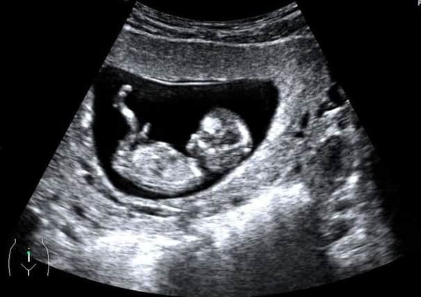 Real image scan of a 12 week pregnancy, from the NHS