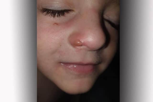 A young child suffers facial blistering after innocently smelling what appears to be a poisonous plant