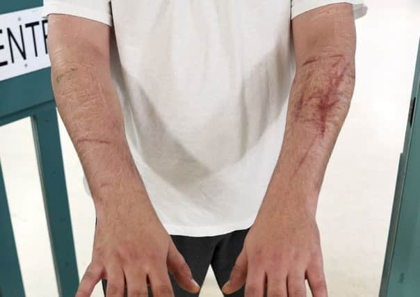 Photo of a prisoner at Maghaberry Prison, Northern Ireland holding out his arms showing self-harm. More than 400 incidents of self-harm by cutting were recorded at Maghaberry prison in the past year.