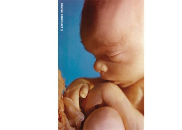 Image of a foetus at 20 weeks. From the Society for Protection of the Unborn Child