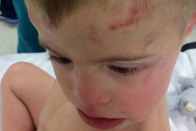 Undated family handout photo of 5-year-old Riley Gedge-Duffy, and the injuries he sustained after becoming trapped inside a tumble dryer. Riley was saved by the family dog Teddy, a 2-year-old cockapoo. PRESS ASSOCIATION Photo. Issue date: Monday November 14, 2016. A father has told how the family's pet dog saved their son after he became trapped in a tumble dryer. Riley Gedge-Duffy, five, suffered burns to his arms, back and head when the machine automatically started with the boy, who has Down's syndrome, stuck inside. Aaron Duffy said his wife, who was vacuuming at the time, only knew something was wrong when their dog, Teddy - a cockapoo, began to bark. See PA story ULSTER Dog. Photo credit should read: Aaron Duffy/PA Wire

NOTE TO EDITORS: This handout photo may only be used in for editorial reporting purposes for the contemporaneous illustration of events, things or the people in the image or facts mentioned in the caption. Reuse of the picture may require further permission from the copyright holder.