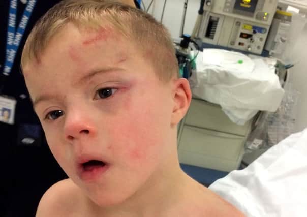 Undated family handout photo of 5-year-old Riley Gedge-Duffy, and the injuries he sustained after becoming trapped inside a tumble dryer. Riley was saved by the family dog Teddy, a 2-year-old cockapoo. PRESS ASSOCIATION Photo. Issue date: Monday November 14, 2016. A father has told how the family's pet dog saved their son after he became trapped in a tumble dryer. Riley Gedge-Duffy, five, suffered burns to his arms, back and head when the machine automatically started with the boy, who has Down's syndrome, stuck inside. Aaron Duffy said his wife, who was vacuuming at the time, only knew something was wrong when their dog, Teddy - a cockapoo, began to bark. See PA story ULSTER Dog. Photo credit should read: Aaron Duffy/PA Wire

NOTE TO EDITORS: This handout photo may only be used in for editorial reporting purposes for the contemporaneous illustration of events, things or the people in the image or facts mentioned in the caption. Reuse of the picture may require further permission from the copyright holder.