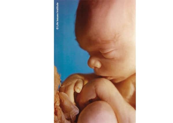 The DUP is pro-life, and could win Catholic support. Above, a foetus at 20 weeks. Image from the Society for Protection of the Unborn Child