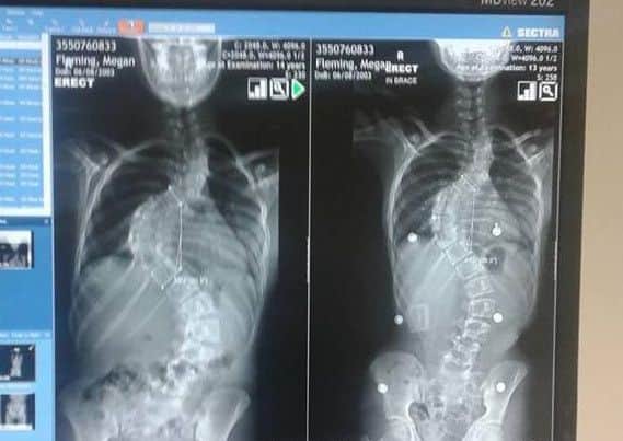An X-ray of Megan's spine (picture courtesy of Karen Fleming).  INCT 40-741-CON